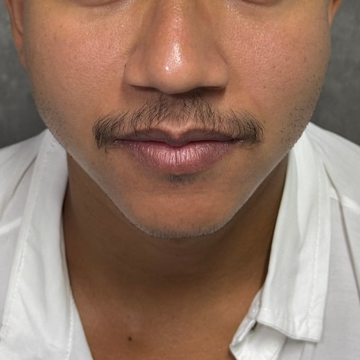 Caso 1, antes do Transplante de Barba