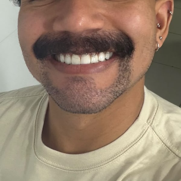 Caso 1, depois do Transplante de Barba