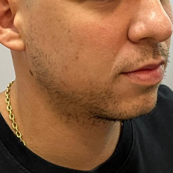 Caso 2, antes do Transplante de Barba