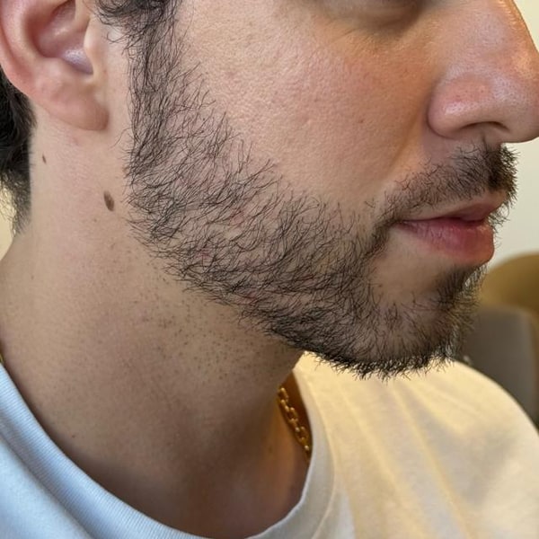 Caso 2, depois do Transplante de Barba