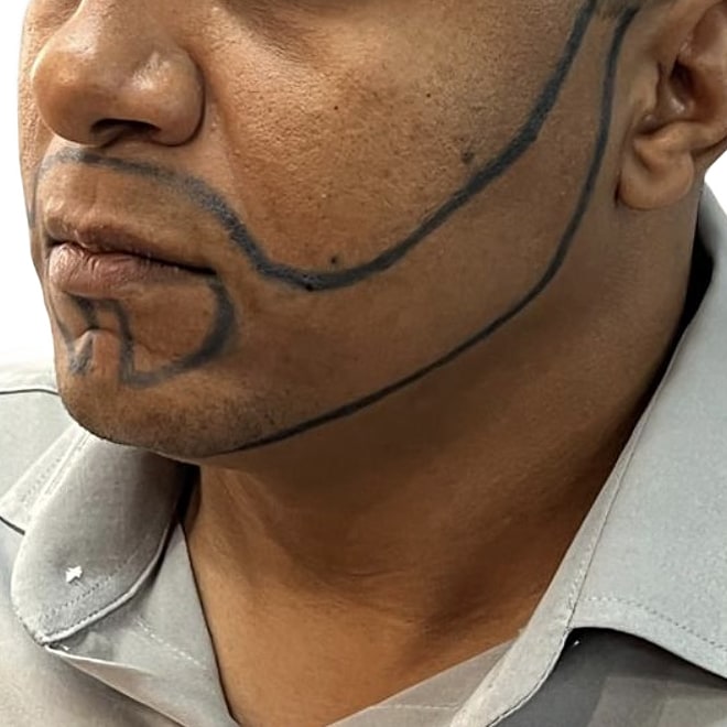 Caso 3, antes do Transplante de Barba