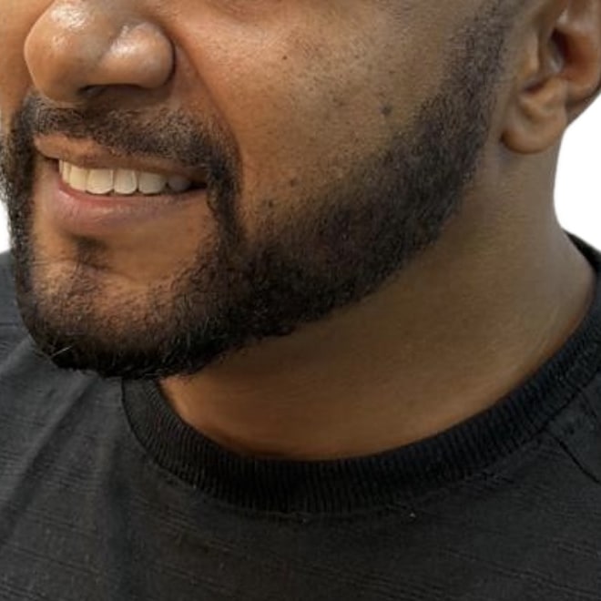 Caso 3, depois do Transplante de Barba