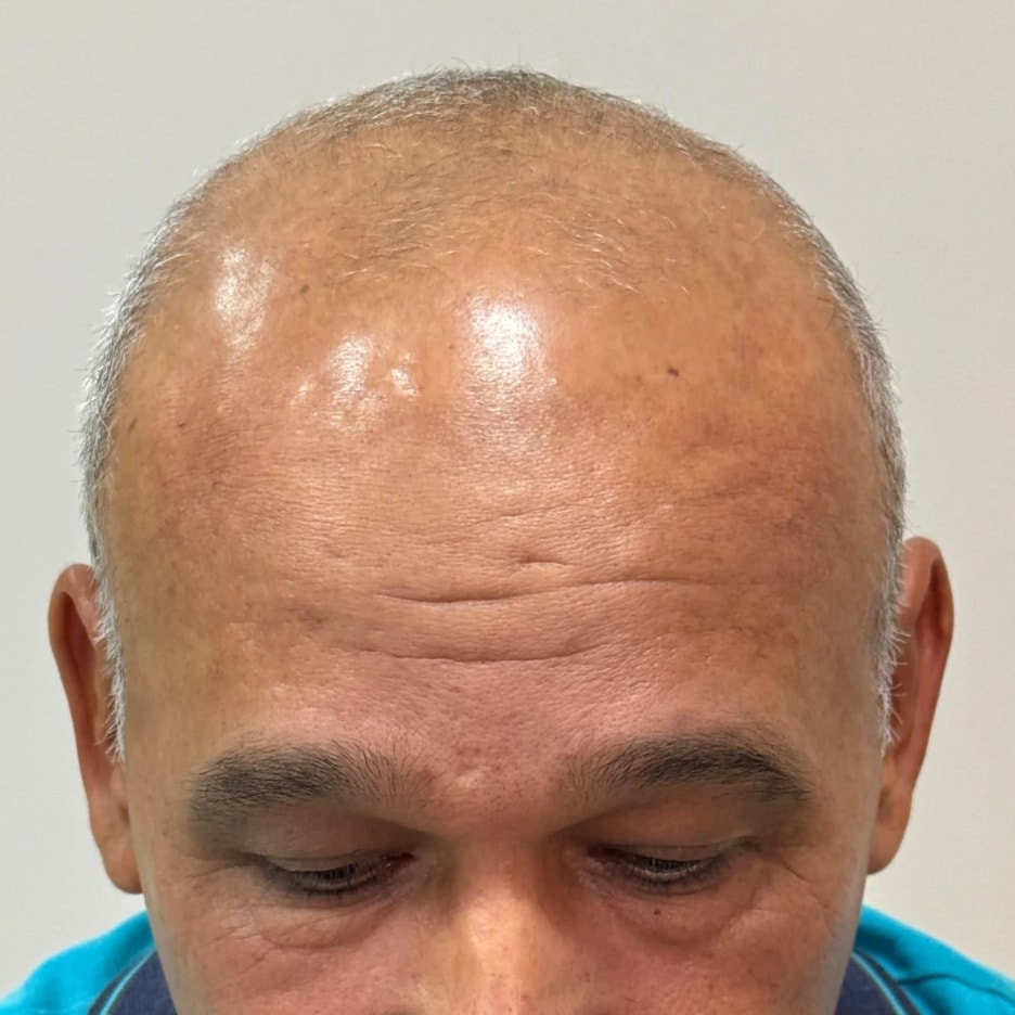 Caso 3, antes do Transplante Capilar