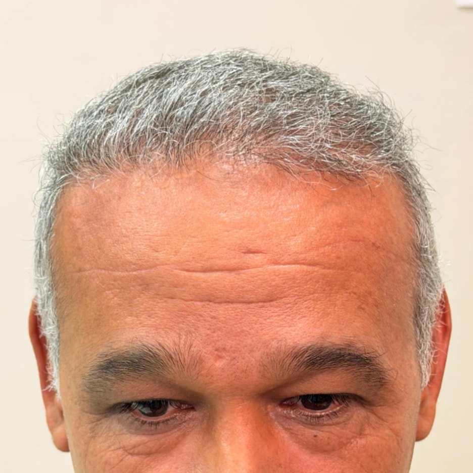 Caso 3, depois do Transplante Capilar